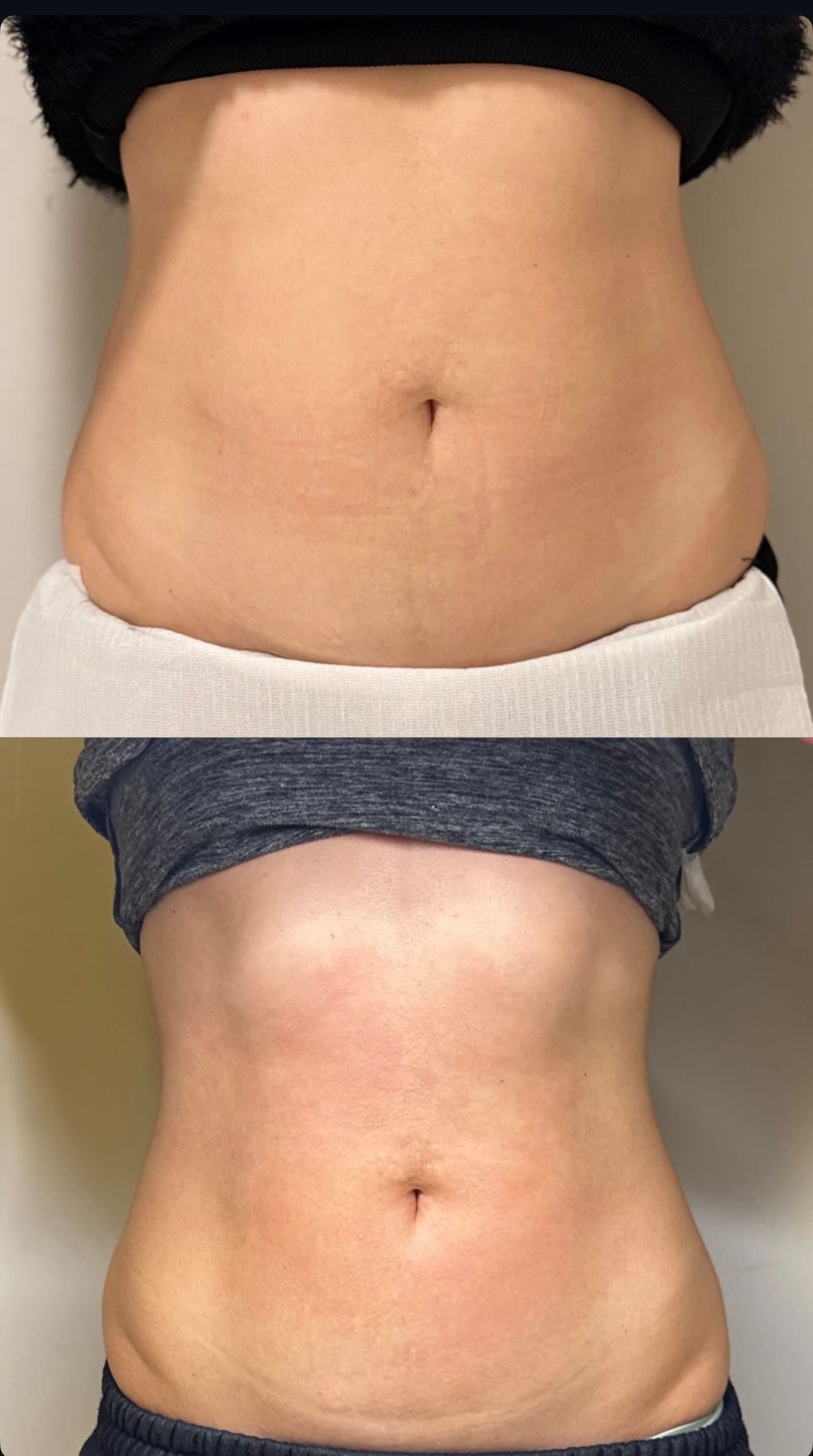 Comparação de antes e depois de resultado corporal na região abdominal