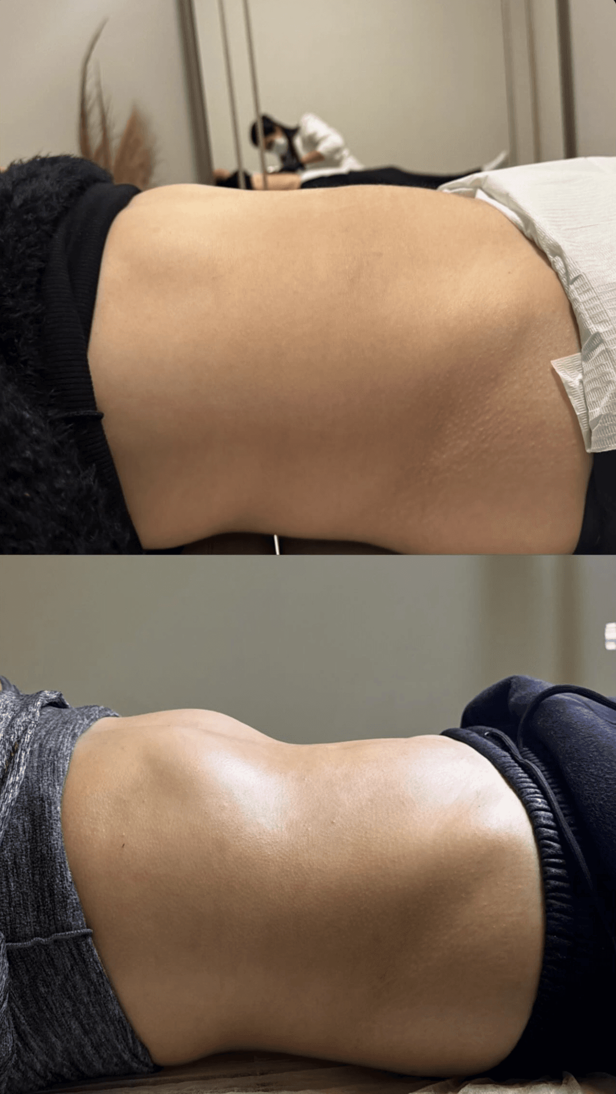 Comparação lateral de antes e depois de resultado corporal na região abdominal