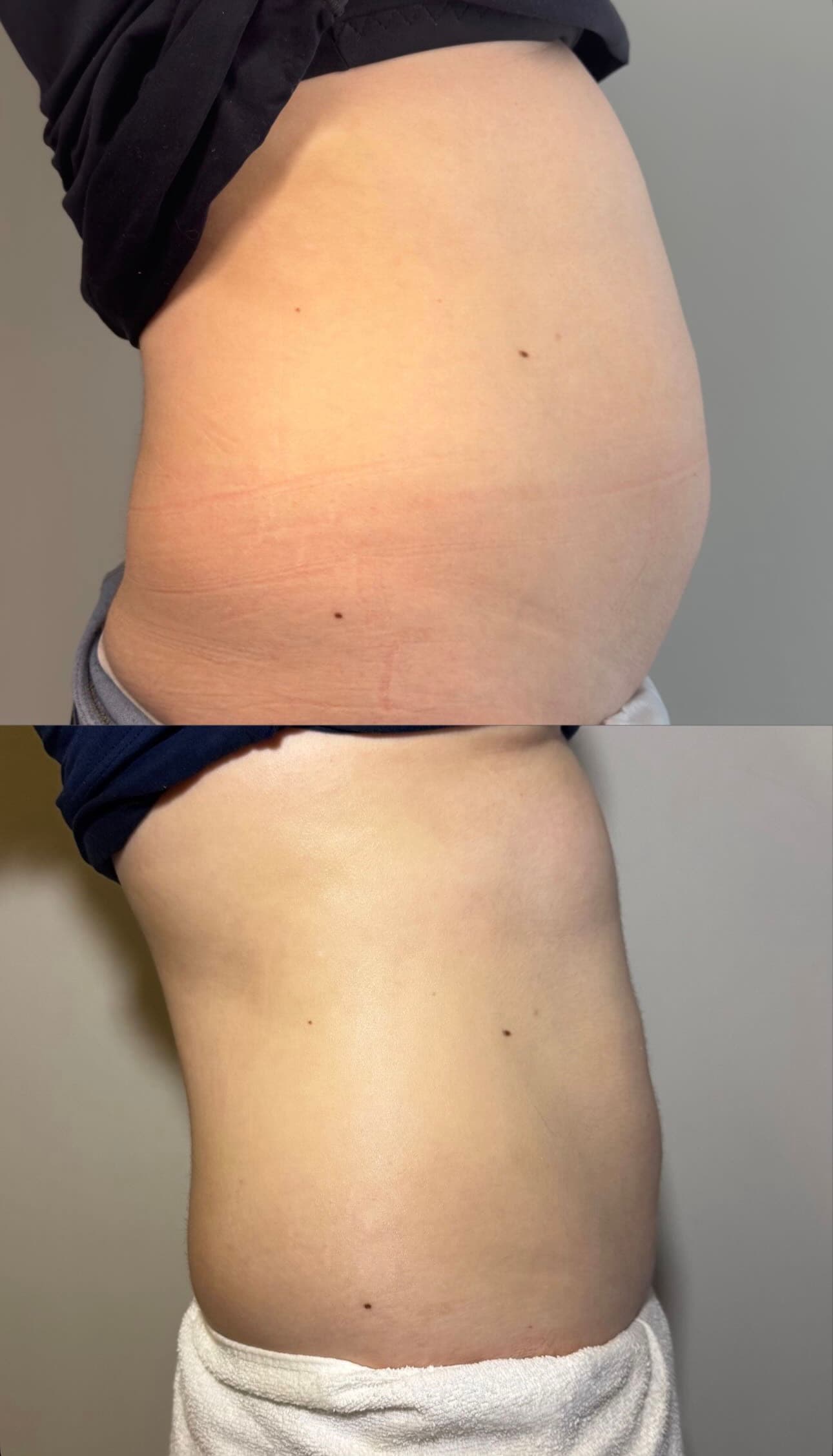 Comparação lateral de antes e depois de cuidado corporal