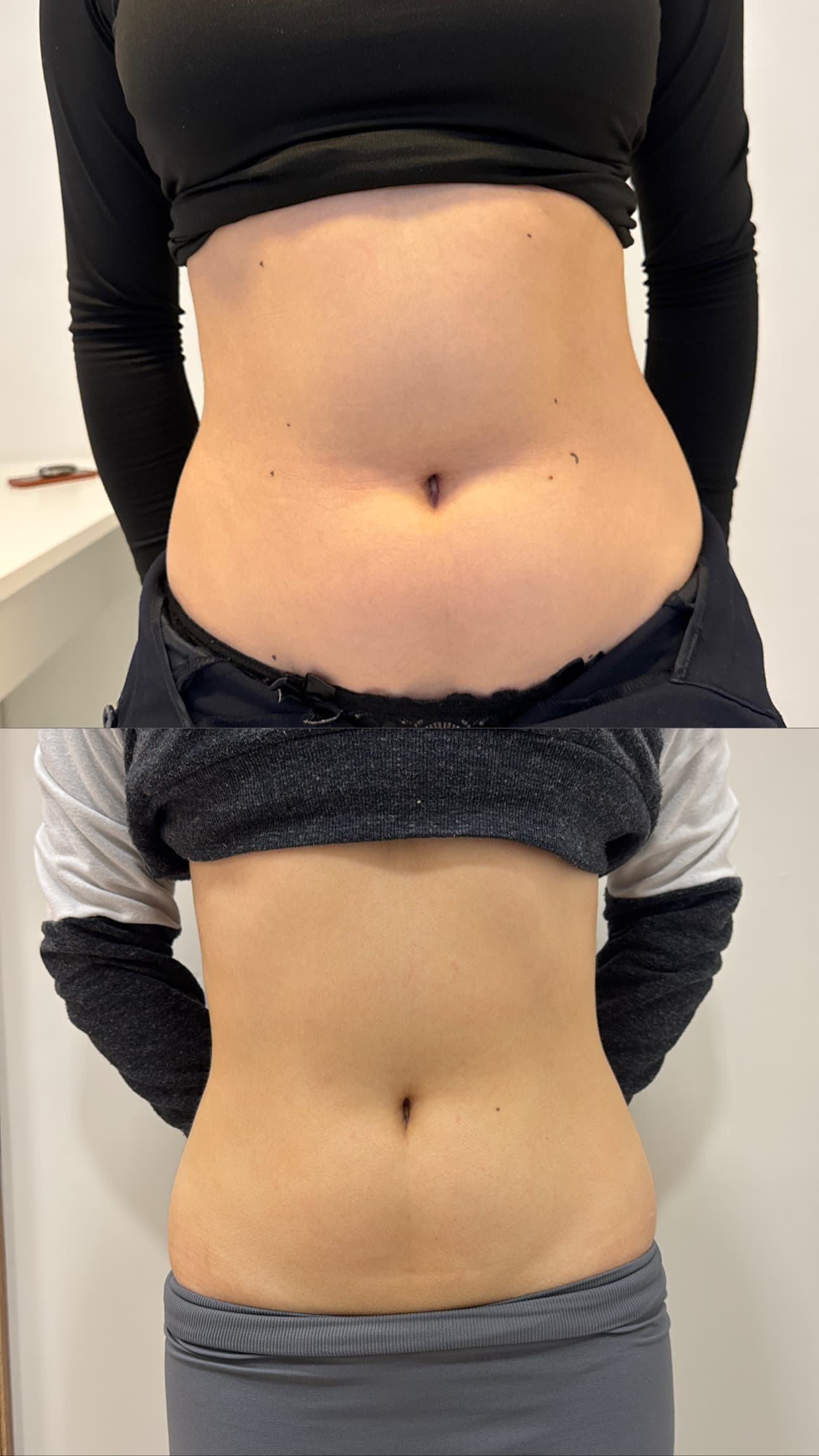 Comparação frontal de antes e depois de resultado corporal