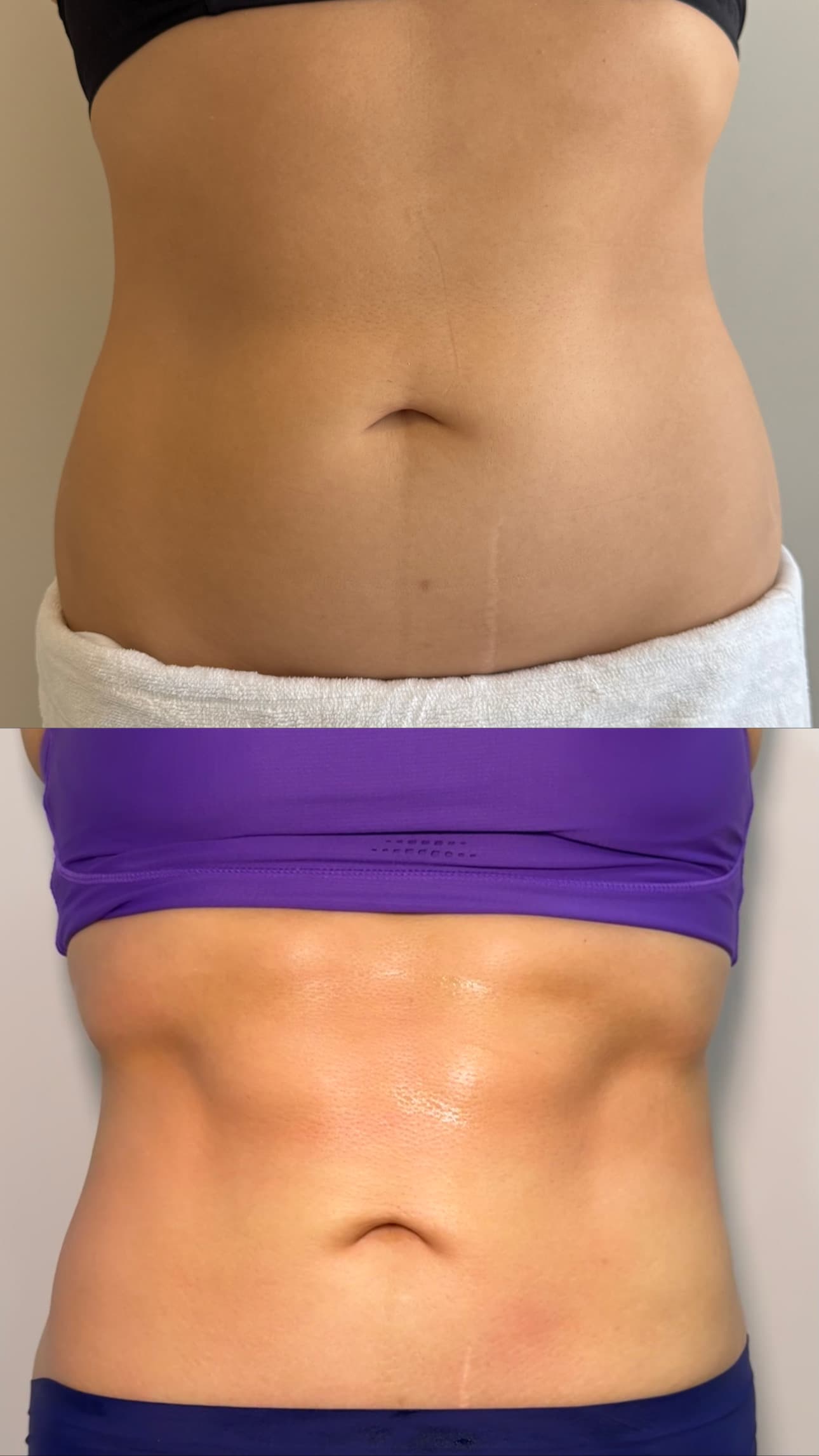 Comparação frontal de antes e depois de cuidado na região abdominal